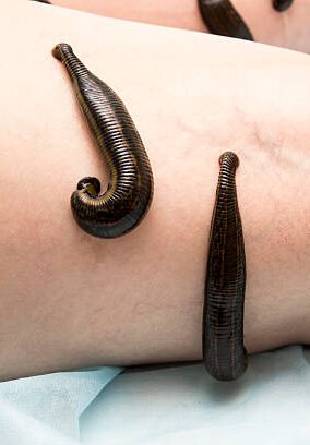 Raktamokshana Treatment in rishikesh