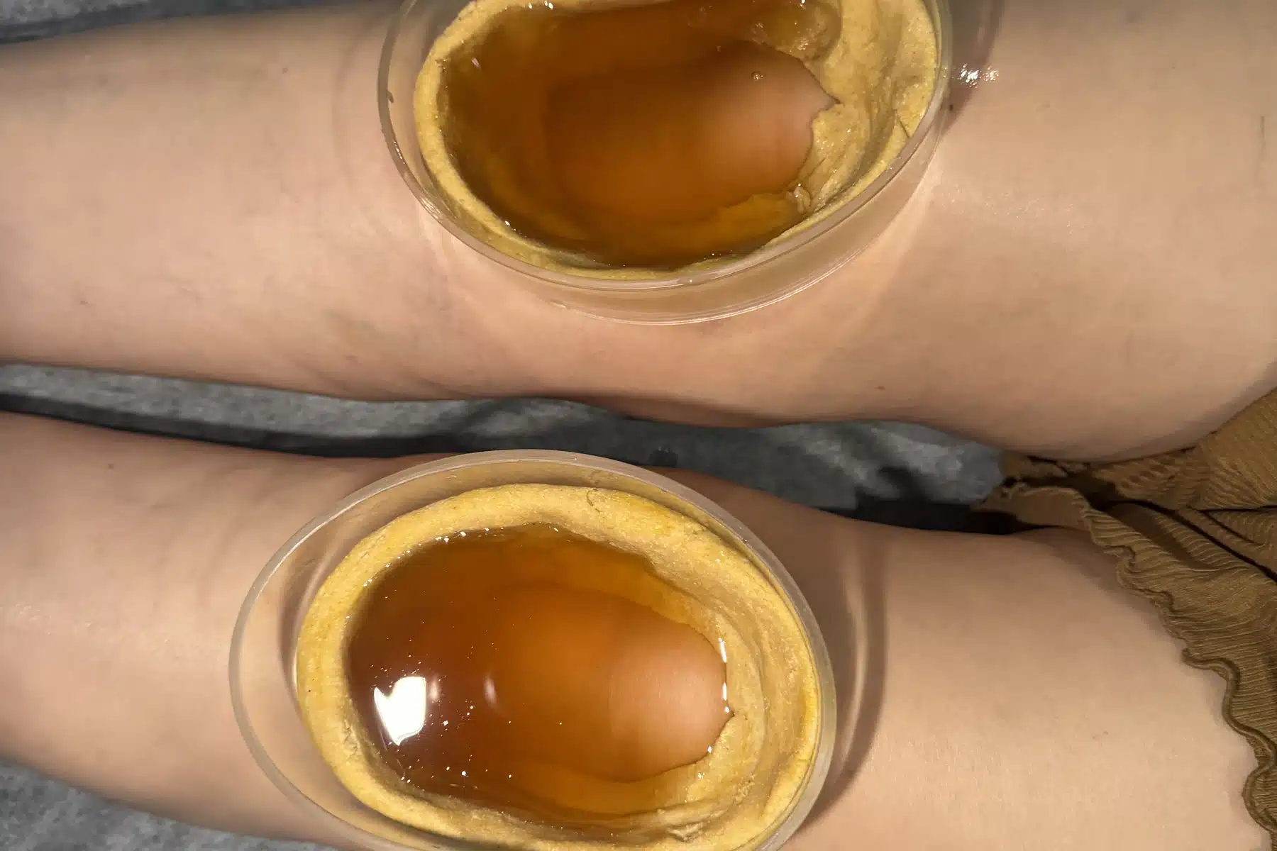 Real Janu Basti knee oil therapy setup at Yan Cure